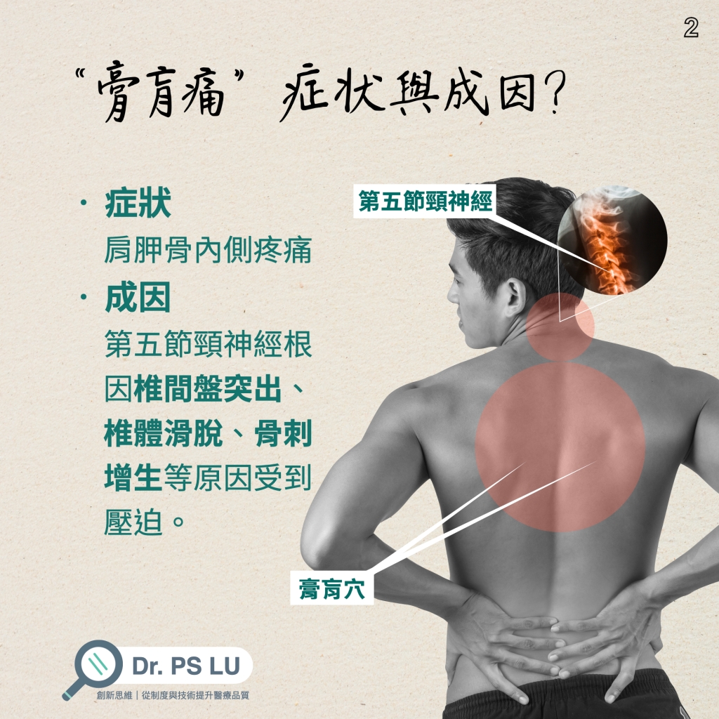 症狀 肩胛骨內側疼痛
成因 第五節頸神經根 因椎間盤突出、 椎體滑脫、骨刺 增生等原因受到 壓迫。